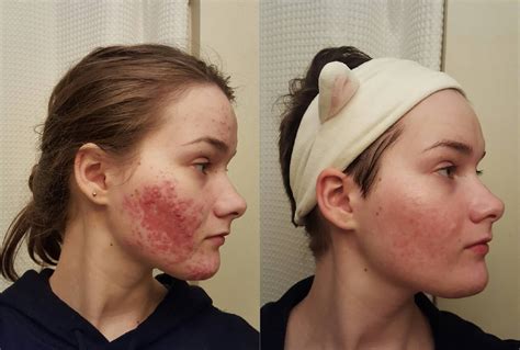 How 50 Different Redditors Cleared Their Acne Using Science!.